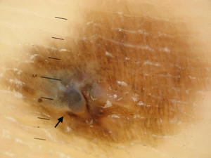 Editdermoscopy_2_2 Editdermoscopy_2_2