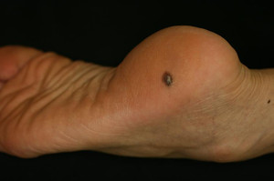 Editmelanoma_macro Editmelanoma_macro