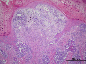 Melanoma_x4_4_5 Melanoma_x4_4_5