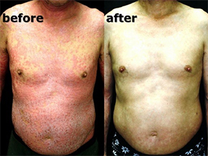 Case_psoriasis_vulgaris_p05