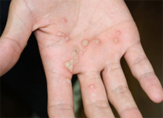 にしむら皮フ科クリニック － 皮膚科・形成外科・アレルギー科 － ＜イボ＞